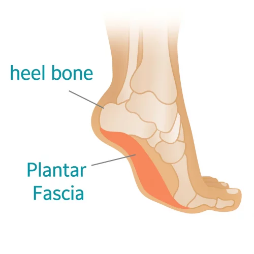 fascitis plantar ejemplo